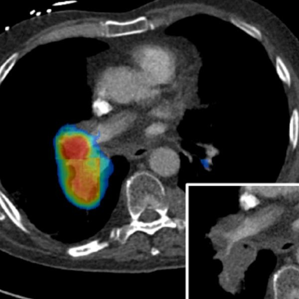 Accuracy of a deep neural network for automated pulmonary embolism detection on dedicated CT pulmonary angiograms